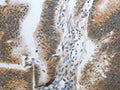 The image on the left is immunohistochemistry of paraffin-embedded Human colon cancer tissue using CSB-PA205008(CST3 Antibody) at dilution 1/20, on the right is treated with synthetic peptide. (Original magnification: ×200)