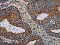 The image on the left is immunohistochemistry of paraffin-embedded Human colon cancer tissue using CSB-PA205015(NDUFA9 Antibody) at dilution 1/30, on the right is treated with fusion protein. (Original magnification: ×200)