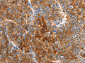 The image on the left is immunohistochemistry of paraffin-embedded Human liver cancer tissue using CSB-PA205503(CBS Antibody) at dilution 1/25, on the right is treated with fusion protein. (Original magnification: ×200)