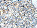 The image on the left is immunohistochemistry of paraffin-embedded Human thyroid cancer tissue using CSB-PA205525(AGBL3 Antibody) at dilution 1/45, on the right is treated with fusion protein. (Original magnification: ×200)