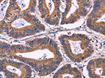 The image on the left is immunohistochemistry of paraffin-embedded Human colon cancer tissue using CSB-PA205578(KIR2DL3/KIR2DL1/KIR2DL4/KIR2DS4 Antibody) at dilution 1/40, on the right is treated with fusion protein. (Original magnification: ×200)