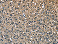 The image on the left is immunohistochemistry of paraffin-embedded Human liver cancer tissue using CSB-PA205920(ENO1 Antibody) at dilution 1/40, on the right is treated with fusion protein. (Original magnification: ×200)