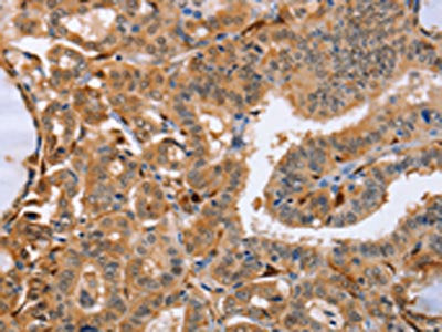 The image on the left is immunohistochemistry of paraffin-embedded Human thyroid cancer tissue using CSB-PA206136(LXN Antibody) at dilution 1/25, on the right is treated with fusion protein. (Original magnification: ×200)
