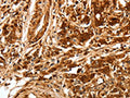 The image on the left is immunohistochemistry of paraffin-embedded Human gastic cancer tissue using CSB-PA206147(TGFBR1 Antibody) at dilution 1/70, on the right is treated with synthetic peptide. (Original magnification: ×200)