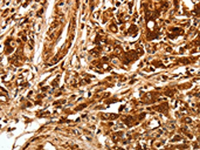 The image on the left is immunohistochemistry of paraffin-embedded Human gastic cancer tissue using CSB-PA206147(TGFBR1 Antibody) at dilution 1/70, on the right is treated with synthetic peptide. (Original magnification: ×200)