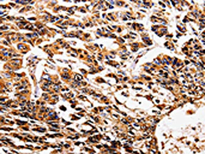 The image on the left is immunohistochemistry of paraffin-embedded Human lung cancer tissue using CSB-PA206405(IL17RD Antibody) at dilution 1/5, on the right is treated with fusion protein. (Original magnification: ×200)