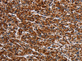 The image on the left is immunohistochemistry of paraffin-embedded Human prostate cancer tissue using CSB-PA206609(LRRC15 Antibody) at dilution 1/60, on the right is treated with fusion protein. (Original magnification: ×200)