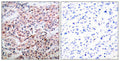 Immunohistochemical analysis of paraffin-embedded human breast carcinoma tissue, using BCL-2 (phospho-Thr56) antibody.