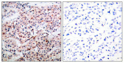 Immunohistochemical analysis of paraffin-embedded human breast carcinoma tissue, using BCL-2 (phospho-Thr56) antibody.