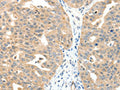 The image on the left is immunohistochemistry of paraffin-embedded Human ovarian cancer tissue using CSB-PA206897(MAP3K14 Antibody) at dilution 1/20, on the right is treated with fusion protein. (Original magnification: ×200)