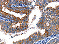 The image on the left is immunohistochemistry of paraffin-embedded Human cervical cancer tissue using CSB-PA207146(TBX22 Antibody) at dilution 1/15, on the right is treated with fusion protein. (Original magnification: ×200)