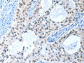 The image on the left is immunohistochemistry of paraffin-embedded Human cervical cancer tissue using CSB-PA207169(RPL15 Antibody) at dilution 1/25, on the right is treated with fusion protein. (Original magnification: ×200)