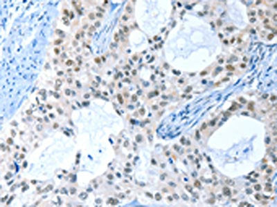 The image on the left is immunohistochemistry of paraffin-embedded Human cervical cancer tissue using CSB-PA207169(RPL15 Antibody) at dilution 1/25, on the right is treated with fusion protein. (Original magnification: ×200)