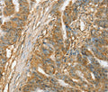 Immunohistochemical analysis of paraffin-embedded Human esophagus cancer tissue using at dilution 1/45.