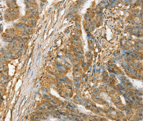 Immunohistochemical analysis of paraffin-embedded Human esophagus cancer tissue using at dilution 1/45.
