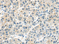The image on the left is immunohistochemistry of paraffin-embedded Human liver cancer tissue using CSB-PA207910(AHI1 Antibody) at dilution 1/25, on the right is treated with synthetic peptide. (Original magnification: ×200)