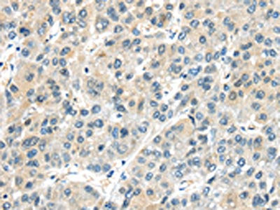 The image on the left is immunohistochemistry of paraffin-embedded Human liver cancer tissue using CSB-PA207910(AHI1 Antibody) at dilution 1/25, on the right is treated with synthetic peptide. (Original magnification: ×200)