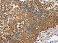 The image on the left is immunohistochemistry of paraffin-embedded Human cervical cancer tissue using CSB-PA208126(AGO1 Antibody) at dilution 1/40, on the right is treated with synthetic peptide. (Original magnification: ×200)