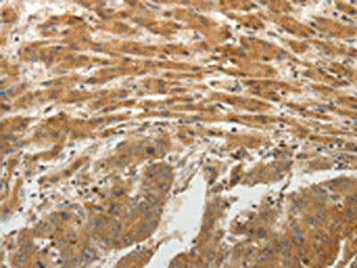The image on the left is immunohistochemistry of paraffin-embedded Human liver cancer tissue using CSB-PA208349(SPATA17 Antibody) at dilution 1/25, on the right is treated with fusion protein. (Original magnification: ×200)