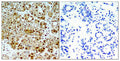 Immunohistochemical analysis of paraffin-embedded human breast carcinoma tissue using HSP90B(Ab-254) Antibody(left) or the same antibody preincubated with blocking peptide(right).