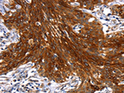 The image on the left is immunohistochemistry of paraffin-embedded Human cervical cancer tissue using CSB-PA208890(MAPK9 Antibody) at dilution 1/30, on the right is treated with synthetic peptide. (Original magnification: ×200)