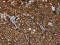 The image on the left is immunohistochemistry of paraffin-embedded Human breast cancer tissue using CSB-PA209003(ERBB4 Antibody) at dilution 1/40, on the right is treated with fusion protein. (Original magnification: ×200)