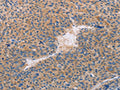 The image on the left is immunohistochemistry of paraffin-embedded Human liver cancer tissue using CSB-PA209503(CASP10 Antibody) at dilution 1/30, on the right is treated with fusion protein. (Original magnification: ×200)