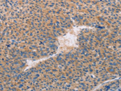 The image on the left is immunohistochemistry of paraffin-embedded Human liver cancer tissue using CSB-PA209503(CASP10 Antibody) at dilution 1/30, on the right is treated with fusion protein. (Original magnification: ×200)