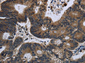 The image on the left is immunohistochemistry of paraffin-embedded Human colon cancer tissue using CSB-PA209664(GK Antibody) at dilution 1/60, on the right is treated with fusion protein. (Original magnification: ×200)
