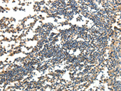The image on the left is immunohistochemistry of paraffin-embedded Human tonsil tissue using CSB-PA209919(SPAG8 Antibody) at dilution 1/30, on the right is treated with fusion protein. (Original magnification: ×200)