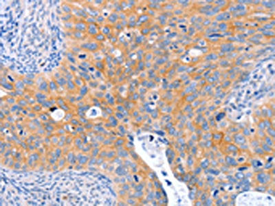 The image on the left is immunohistochemistry of paraffin-embedded Human cervical cancer tissue using CSB-PA210249(ABO Antibody) at dilution 1/50, on the right is treated with synthetic peptide. (Original magnification: ×200)