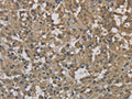 The image on the left is immunohistochemistry of paraffin-embedded Human thyroid cancer tissue using CSB-PA210409(DCTN3 Antibody) at dilution 1/70, on the right is treated with fusion protein. (Original magnification: ×200)