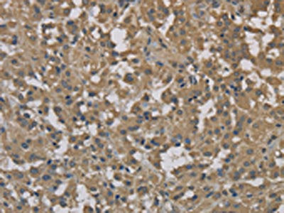 The image on the left is immunohistochemistry of paraffin-embedded Human thyroid cancer tissue using CSB-PA210409(DCTN3 Antibody) at dilution 1/70, on the right is treated with fusion protein. (Original magnification: ×200)
