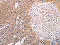 The image on the left is immunohistochemistry of paraffin-embedded Human cervical cancer tissue using CSB-PA210688(DCT Antibody) at dilution 1/25, on the right is treated with fusion protein. (Original magnification: ×200)