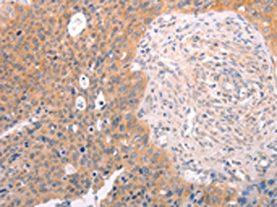 The image on the left is immunohistochemistry of paraffin-embedded Human cervical cancer tissue using CSB-PA210688(DCT Antibody) at dilution 1/25, on the right is treated with fusion protein. (Original magnification: ×200)
