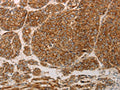 The image on the left is immunohistochemistry of paraffin-embedded Human liver cancer tissue using CSB-PA210969(PRDX3 Antibody) at dilution 1/50, on the right is treated with synthetic peptide. (Original magnification: ×200)