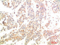 Immunohistochemical analysis of paraffin-embedded Human Breast Carcinoma Tissue using MEK3 Rabbit pAb diluted at 1:200