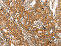 The image on the left is immunohistochemistry of paraffin-embedded Human gastic cancer tissue using CSB-PA211774(MMP2 Antibody) at dilution 1/60, on the right is treated with synthetic peptide. (Original magnification: ×200)