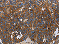 The image on the left is immunohistochemistry of paraffin-embedded Human ovarian cancer tissue using CSB-PA211824(LGALS2 Antibody) at dilution 1/30, on the right is treated with fusion protein. (Original magnification: ×200)