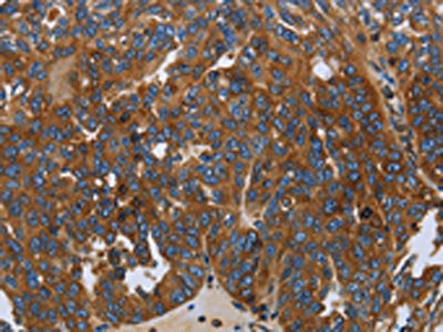 The image on the left is immunohistochemistry of paraffin-embedded Human ovarian cancer tissue using CSB-PA211824(LGALS2 Antibody) at dilution 1/30, on the right is treated with fusion protein. (Original magnification: ×200)