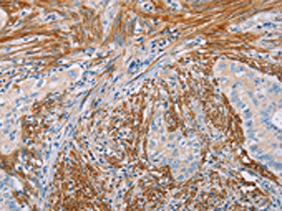 The image on the left is immunohistochemistry of paraffin-embedded Human cervical cancer tissue using CSB-PA211882(KLK4 Antibody) at dilution 1/15, on the right is treated with fusion protein. (Original magnification: ×200)
