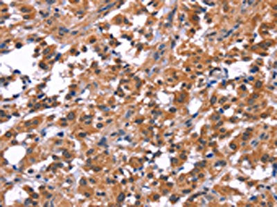 The image on the left is immunohistochemistry of paraffin-embedded Human thyroid cancer tissue using CSB-PA212653(PIP5K1B Antibody) at dilution 1/30, on the right is treated with fusion protein. (Original magnification: ×200)