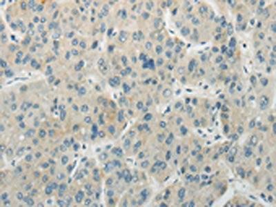 The image on the left is immunohistochemistry of paraffin-embedded Human liver cancer tissue using CSB-PA212701(AICDA Antibody) at dilution 1/35, on the right is treated with synthetic peptide. (Original magnification: ×200)