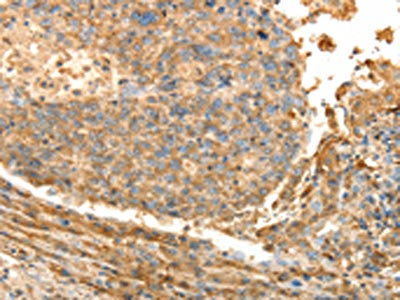 The image on the left is immunohistochemistry of paraffin-embedded Human liver cancer tissue using CSB-PA212713(PSMD9 Antibody) at dilution 1/40, on the right is treated with fusion protein. (Original magnification: ×200)
