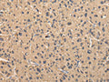 The image on the left is immunohistochemistry of paraffin-embedded Human liver cancer tissue using CSB-PA212919(BMP4 Antibody) at dilution 1/40, on the right is treated with fusion protein. (Original magnification: ×200)