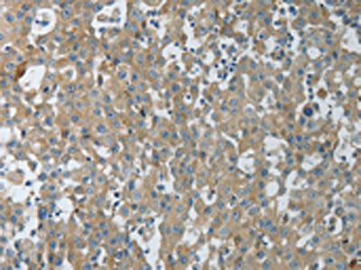 The image on the left is immunohistochemistry of paraffin-embedded Human breast cancer tissue using CSB-PA212989(CXCR3 Antibody) at dilution 1/15, on the right is treated with fusion protein. (Original magnification: ×200)