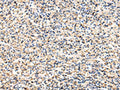 The image on the left is immunohistochemistry of paraffin-embedded Human prostate cancer tissue using CSB-PA213301(VCAM1 Antibody) at dilution 1/30, on the right is treated with fusion protein. (Original magnification: ×200)