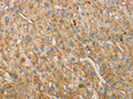 The image on the left is immunohistochemistry of paraffin-embedded Human liver cancer tissue using CSB-PA213506(VTN Antibody) at dilution 1/40, on the right is treated with fusion protein. (Original magnification: ×200)