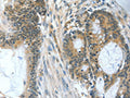The image on the left is immunohistochemistry of paraffin-embedded Human colon cancer tissue using CSB-PA213653(BAD Antibody) at dilution 1/60, on the right is treated with fusion protein. (Original magnification: ×200)