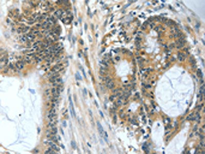 The image on the left is immunohistochemistry of paraffin-embedded Human colon cancer tissue using CSB-PA213653(BAD Antibody) at dilution 1/60, on the right is treated with fusion protein. (Original magnification: ×200)